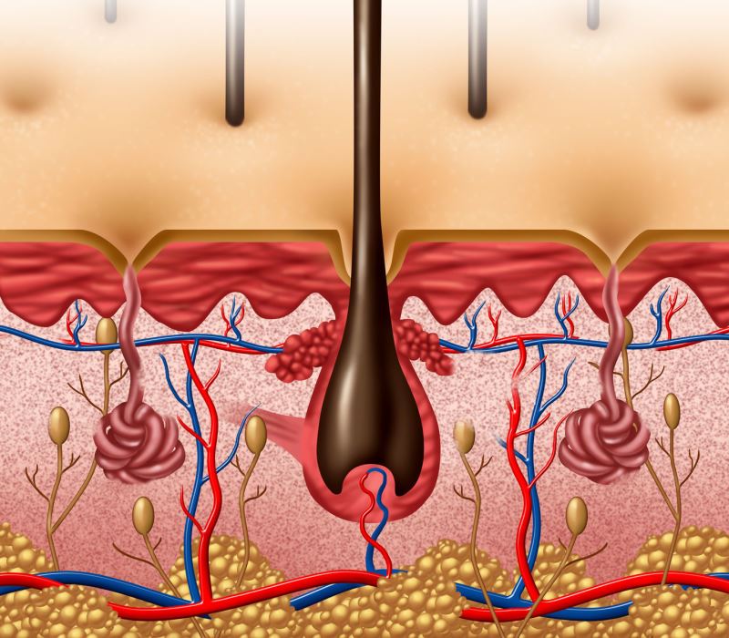 Alopecia androgénica femenina