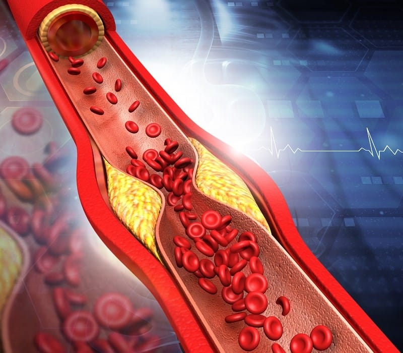¿Angina de pecho o infarto? Aprende a distinguirlos