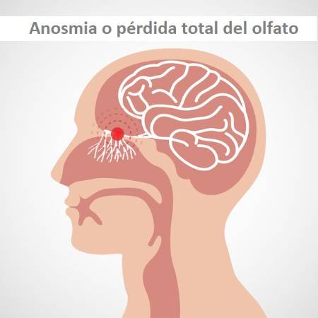 La anosmia o pérdida total del olfato