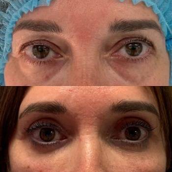 El antes y el después de la blefaroplastia sin cirugía