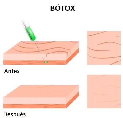 Antes y después del bótox
