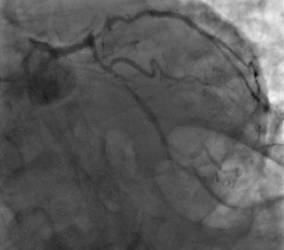 Arteria antes de la intervención