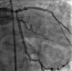 Arteria después de la intervención