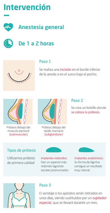 Cómo se realiza el aumento de pecho