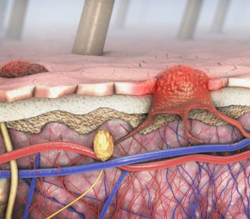 Avances en el tratamiento del melanoma