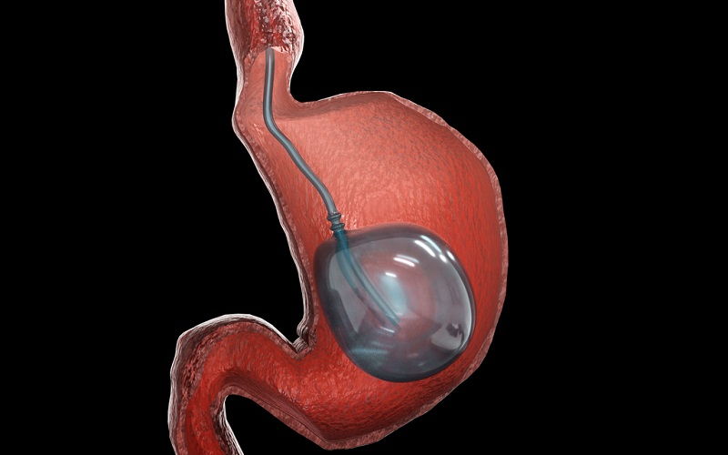 Balón intragástrico para tratar la obesidad