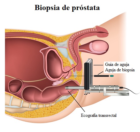 Ilustración de cómo se realiza la biopsia de próstata