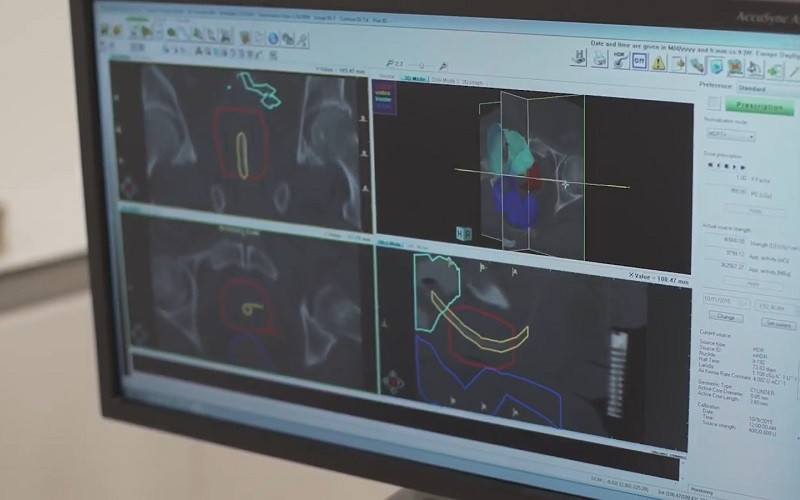 Nueva técnica de braquiterapia para el tratamiento del cáncer