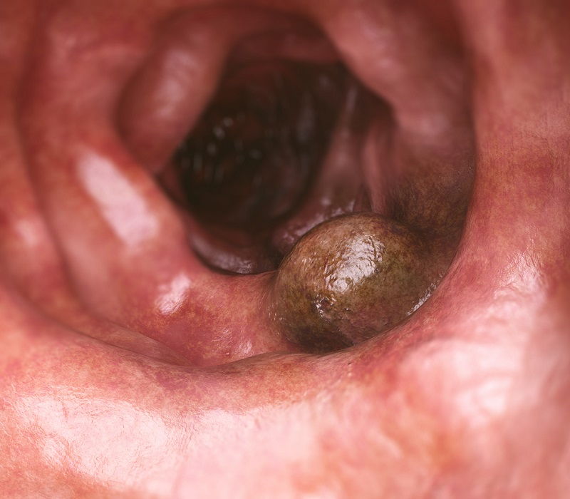 Cáncer de colon, en primer plano