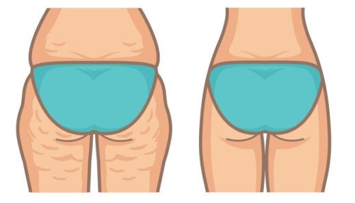 Piernas con celulitis frente a piernas sin celulitis
