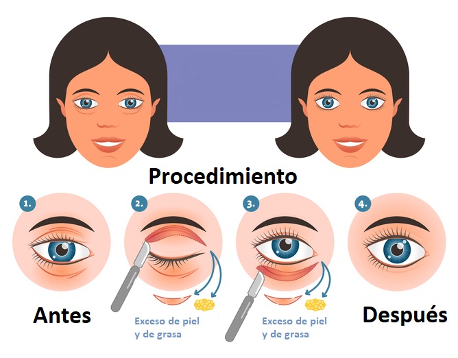 ¿Cómo se realiza la blefaroplastia para eliminar bolsas y párpados caídos?