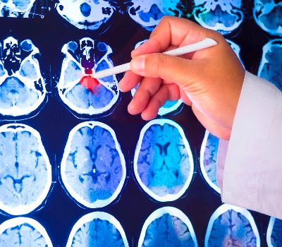 cirugia-fluorescencia-glioma