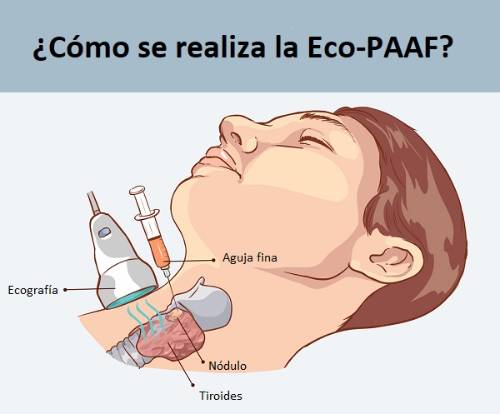 Cómo se realiza la punción-aspiración mediante la Eco-PAAF