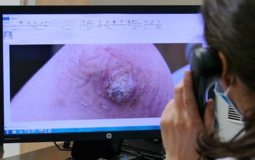 ¿En qué consiste la teledermatología?