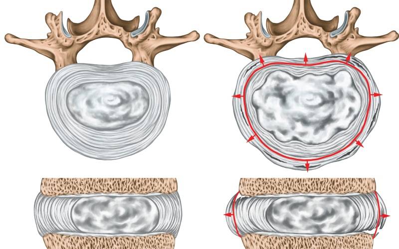 Reemplazo total del disco lumbar