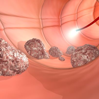 Interior del colon durante la colonoscopia