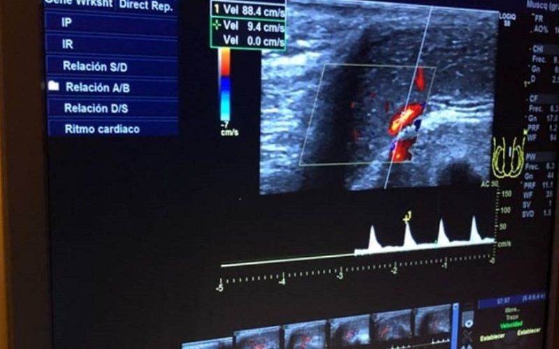 Mediciones en tiempo real de la ecografía Doppler