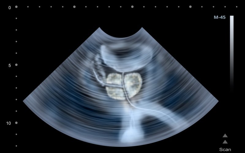 Ecografía de próstata