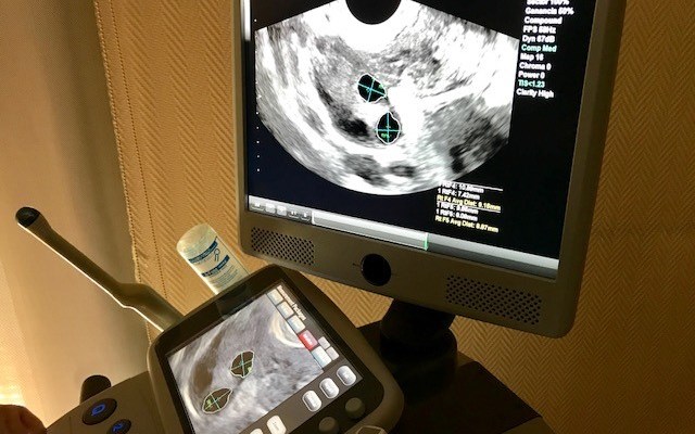 Ecógrafo de gran precisión para reproducción asistida