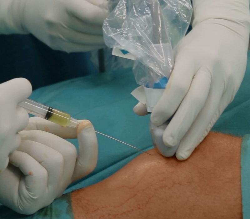 Ensayo clínico con células madre
