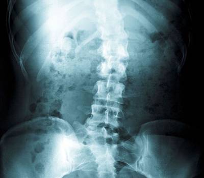 Escoliosis idiopatica