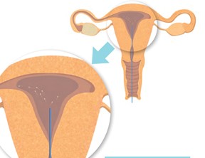 Inseminación artificial