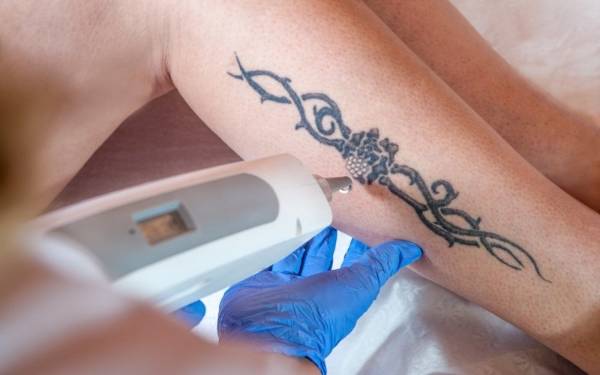 Láser para eliminar tatuajes
