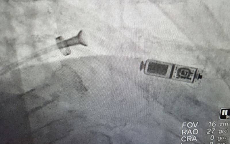 Marcapasos inalámbrico