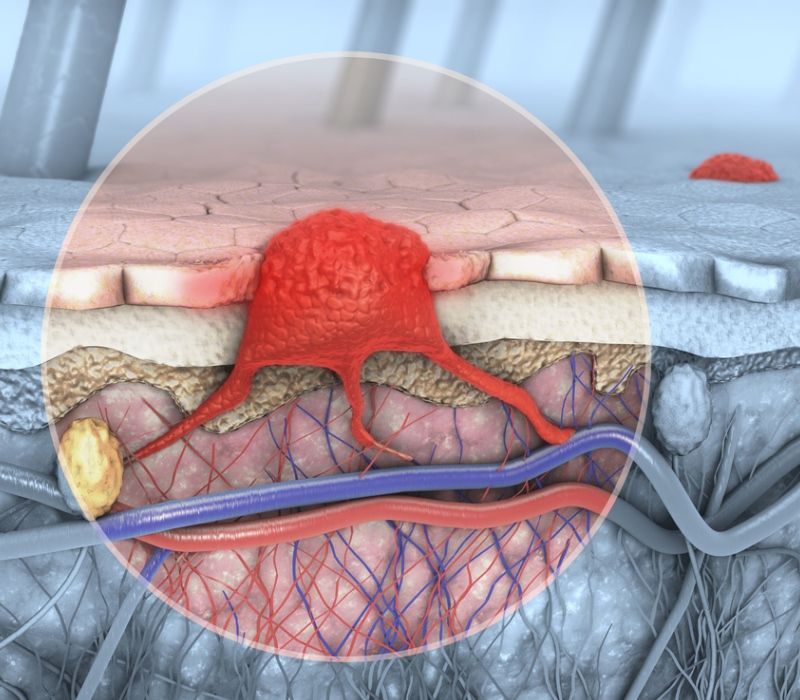 Melanoma: síntomas, diagnóstico y tratamientos