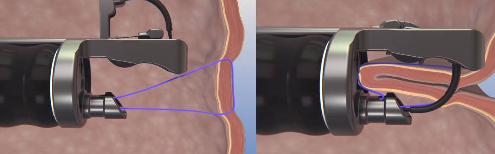 Método Apollo o Endosleeve