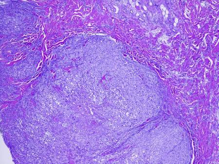 Micrografía de un melanoma
