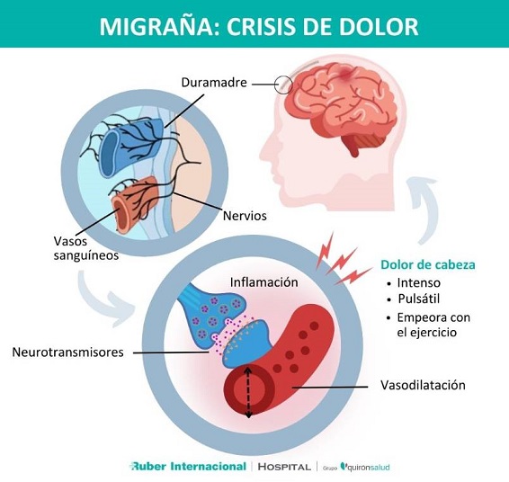 ¿Qué es la migraña?