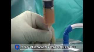 Todo sobre la técnica de liposucción BodyJet