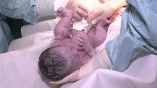 Cesáreas humanizadas