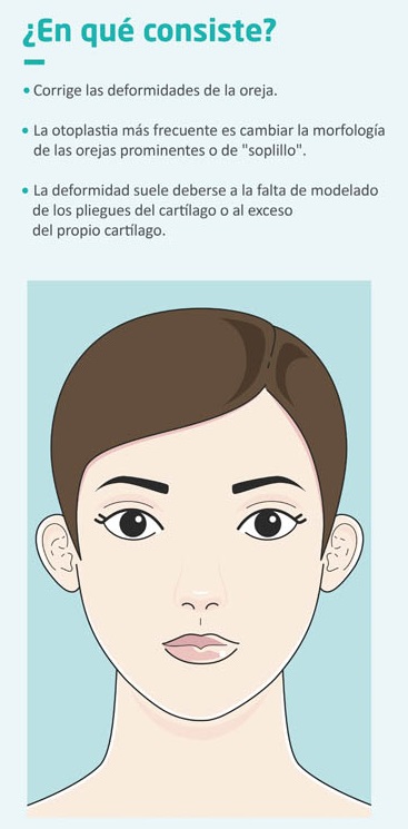 Qué es y en qué consiste la otoplastia