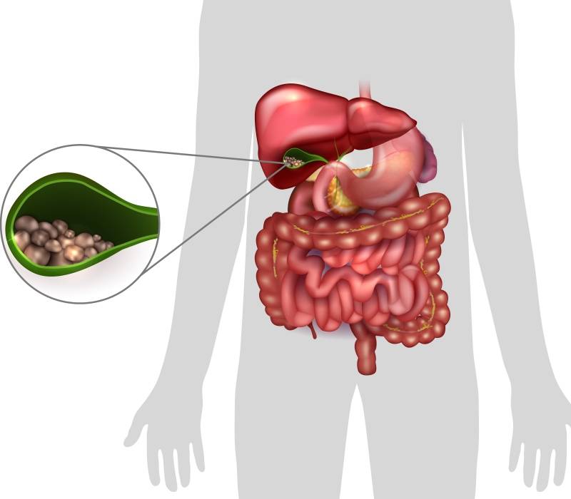 Piedras en la vesícula: qué son y cómo se tratan