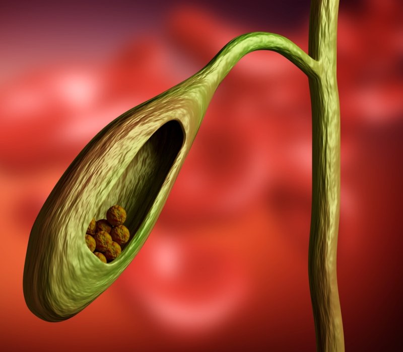 Piedras en la vesícula