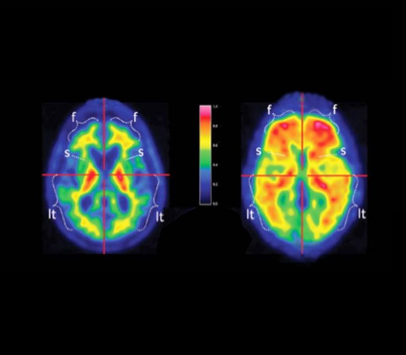 La proteína beta-amiloide es uno de los biomarcadores en el alzhéimer