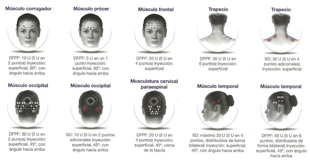Puntos a inyectar para tratar la migraña. Ilustración del prospecto de OnabotA