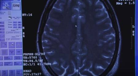 Tratamiento de anorexia por cirugía cerebral