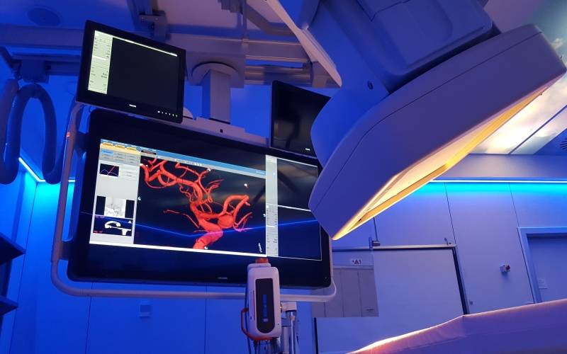 Radilogía intervencionista para el tratamiento del ictus