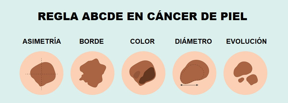 Regla ABCDE para valorar cambios en los lunares (asimetría, bordes, color, diámetro y evolución)