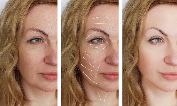 Resultado del lifting facial