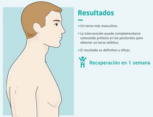 Resultados de la ginecomastia masculina