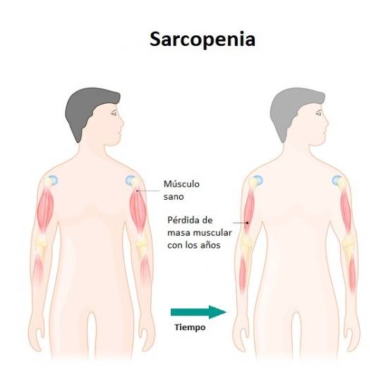 Comparación del estado del músculo con el paso del tiempo