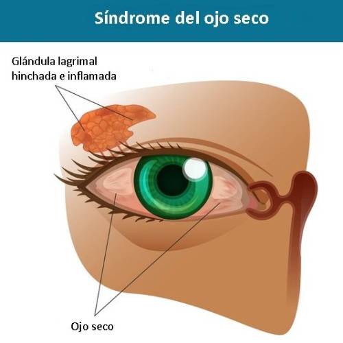 Síndrome del ojo seco