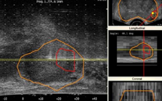 Técnica de detección de cáncer