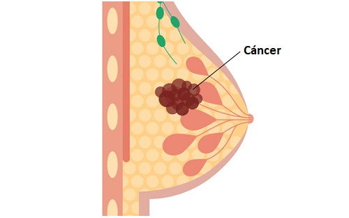 Tipos de cáncer de mama, pronóstico y factores de riesgo