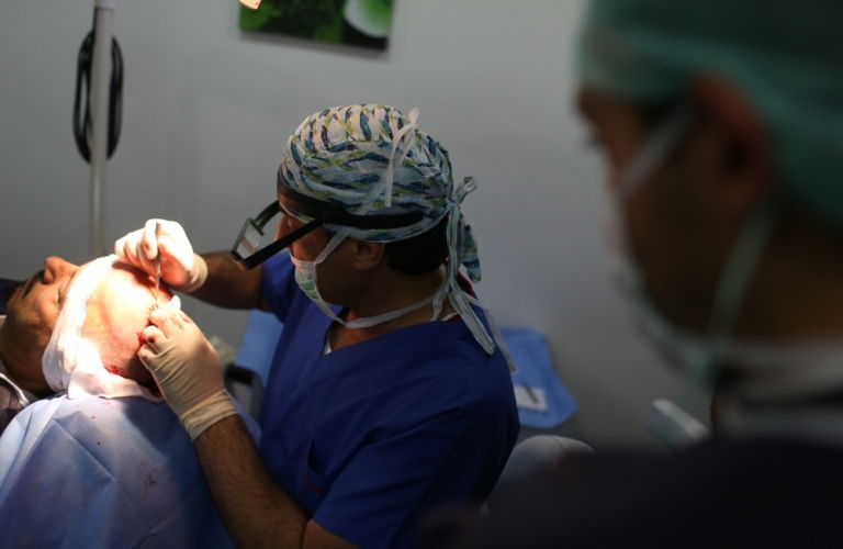 Trasplante capilar para la alopecia