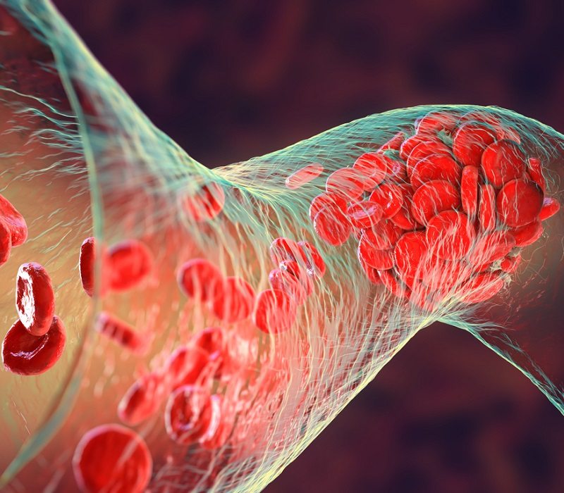 Trombosis del viajero: qué es, factores de riesgo y síntomas